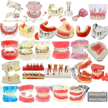 Модель зубов Модель обучения стоматологии Стандартные модели имплантатов Ортодонтическая модель стоматологии Демонстрационное обучение стоматолога